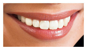 Bleaching, L&auml;cheln, Veneers, Krone, &Auml;sthetik  Zahnmedizin